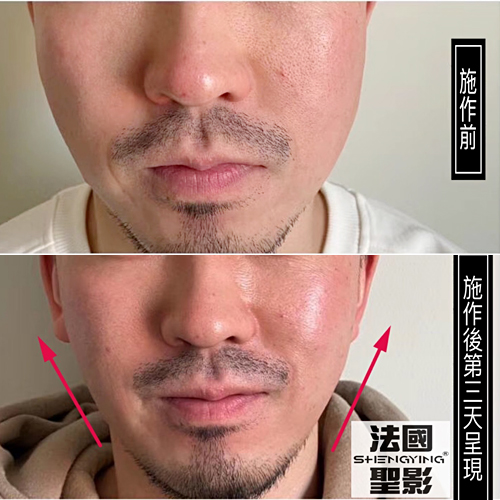 【法國聖影】三線提升技術